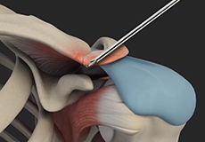 AC Joint Stabilization