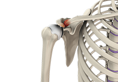 Acromioclavicular (AC) Joint Osteoarthritis