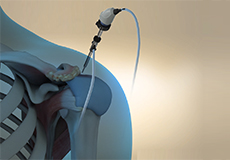 Arthroscopic Acromioplasty