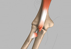 Bicep Tendon Rupture