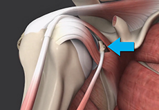 Bony Instability Reconstruction of the Shoulder