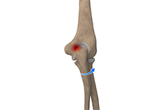 Elbow Impingement