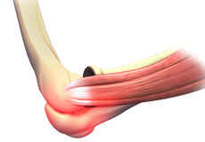 Elbow Sprain