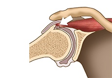 Internal Impingement of the Shoulder