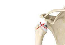 Multidirectional Instability of the Shoulder