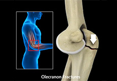 Elbow Fractures