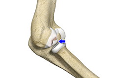 Osteochondritis Dissecans of the Capitellum