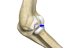 Osteochondritis Dissecans of Elbow