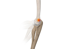 Posterior Impingement of the Elbow