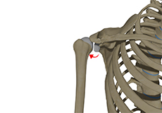 Posterior Shoulder Instability