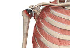 Revision Shoulder Replacement