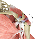 Rotator Cuff Pain