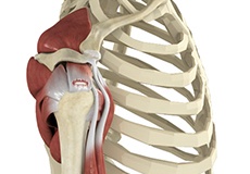 Rotator Cuff Tear