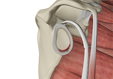 Shoulder Labral Tear with Instability